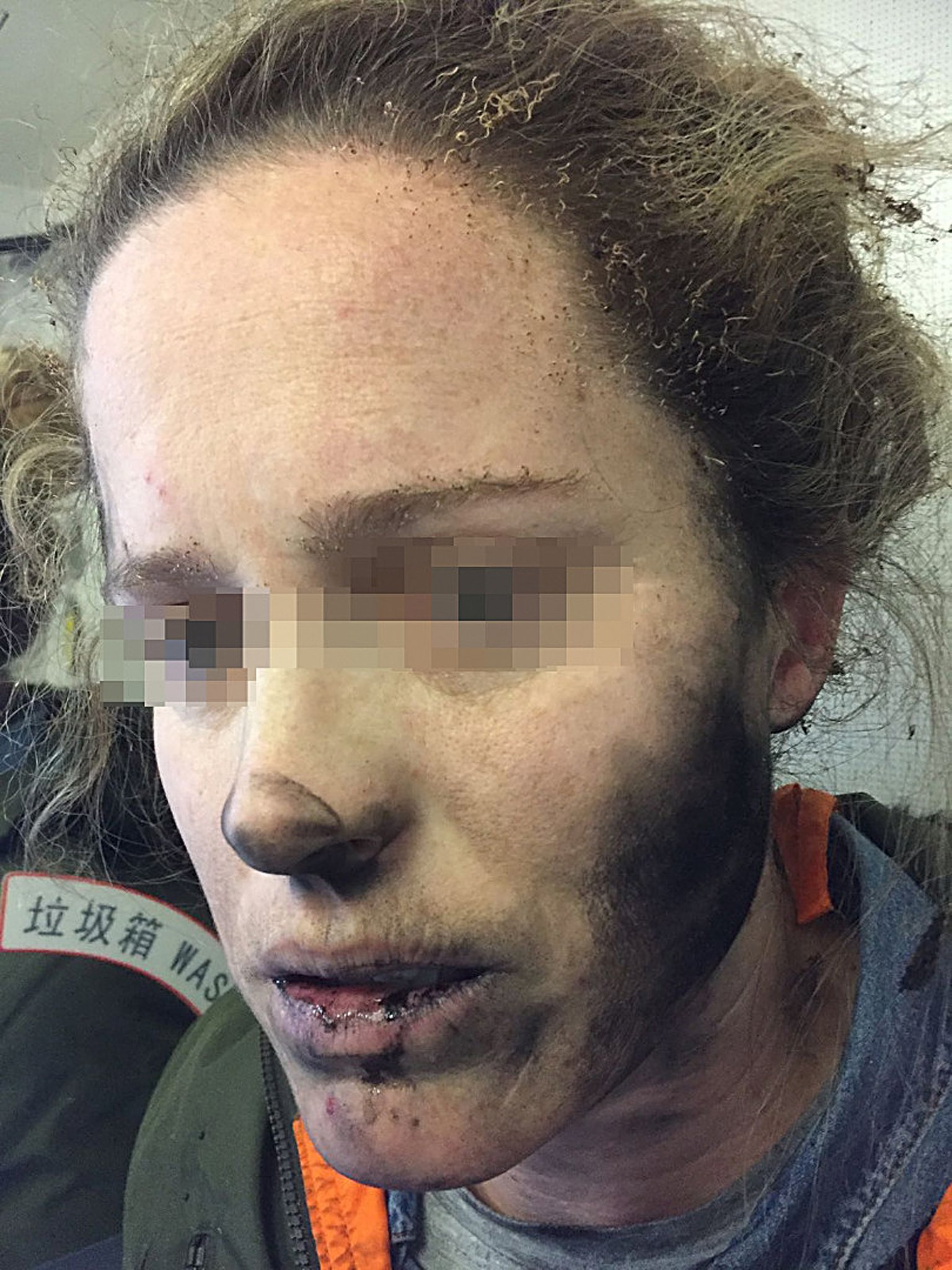 epa05848834 An undated handout photo made available by the Australian Transport Safety Bureau (ATSB) on 15 March 2017 shows a woman with facial injuries after the headphones she was wearing exploded. A woman on a flight from Beijing, China, to Melbourne, Australia, has suffered burns after her battery-operated headphones exploded on her face. The ATSB has warned people to be careful about using battery devices on planes.  EPA/AUSTRALIAN TRANSPORT SAFETY BUREAU HANDOUT -- BEST QUALITY AVAILABLE -- ATTENTION EDITORS: PICTURE PIXELATED AT SOURCE -- AUSTRALIA AND NEW ZEALAND OUT HANDOUT EDITORIAL USE ONLY/NO SALES